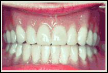 Dental Bridges and Teeth Crowns